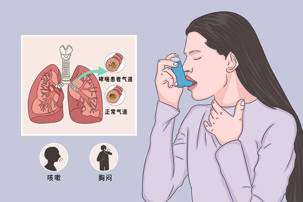 第25個(gè)世界哮喘日：如何防治，一起了解！